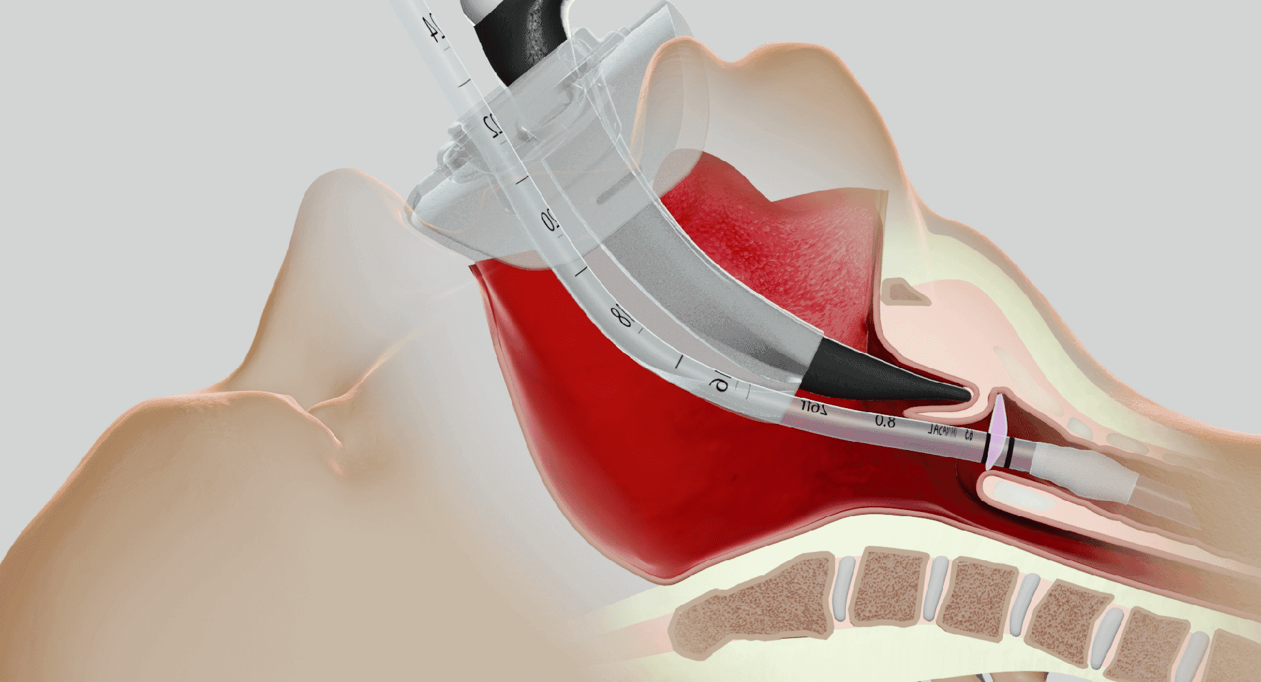 AIRWAY SHIELD